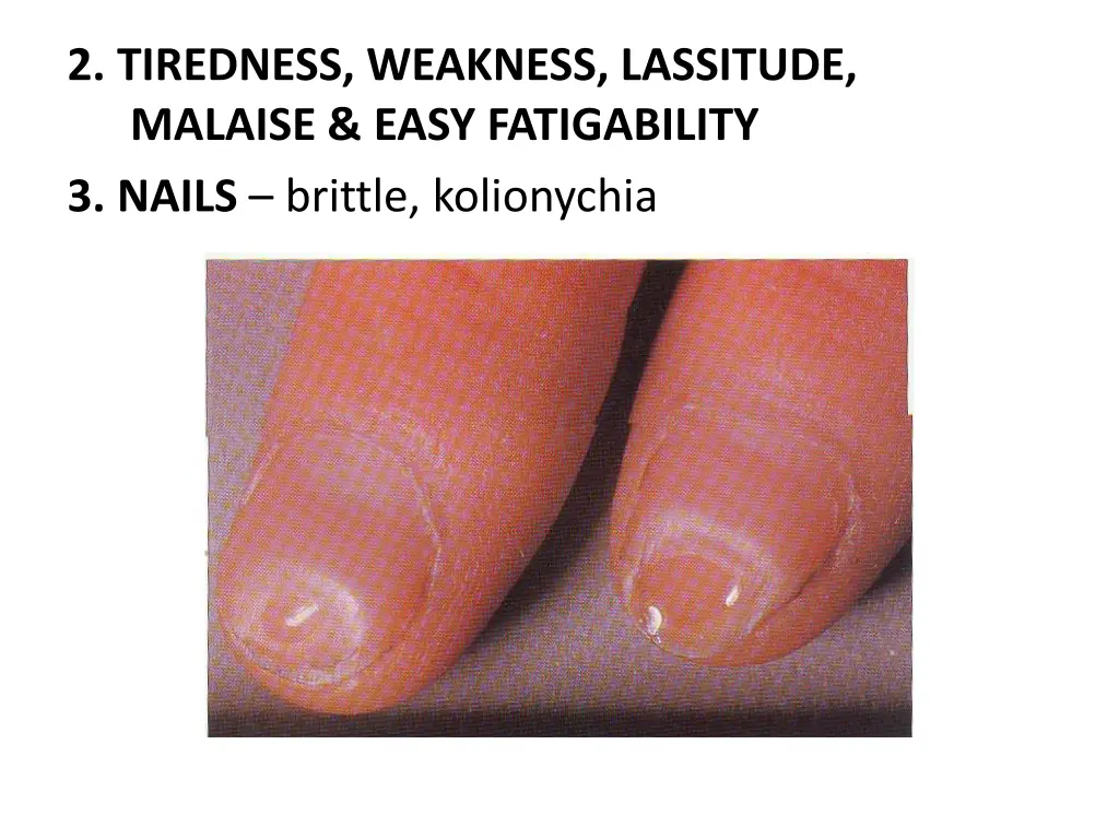 2 tiredness weakness lassitude malaise easy