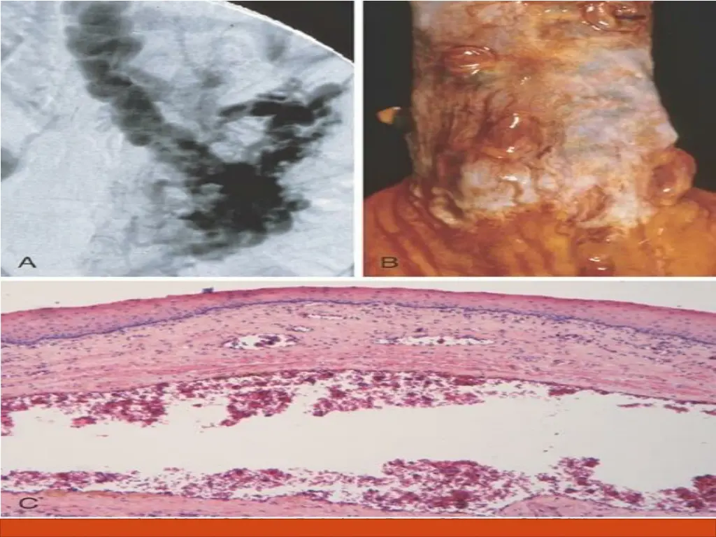 complications of liver cirrhosis 20