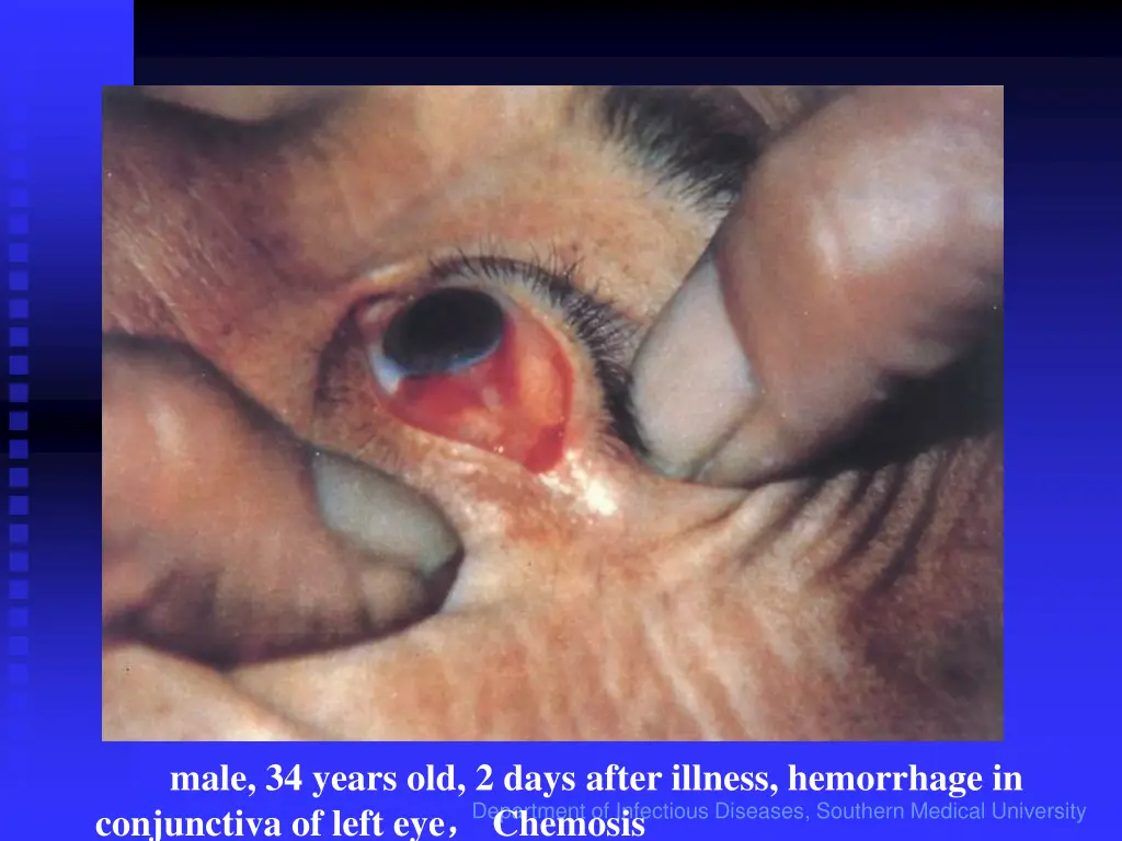 male 34 years old 2 days after illness hemorrhage
