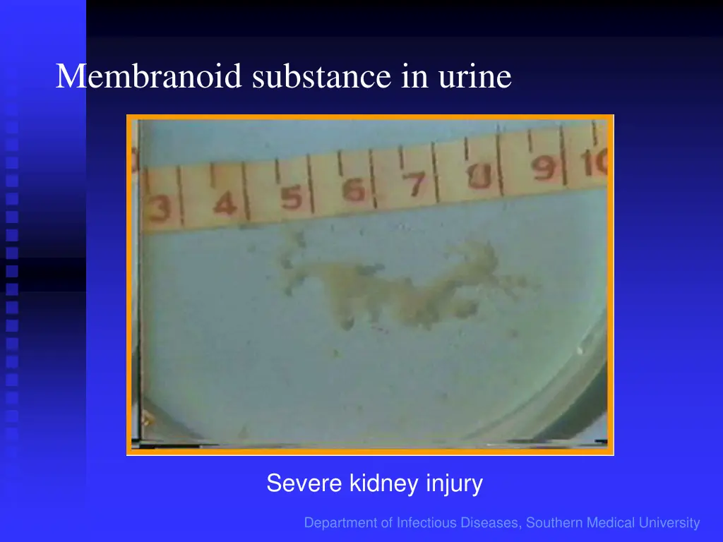 membranoid substance in urine