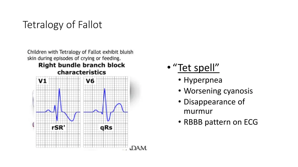 tetralogy of fallot 1