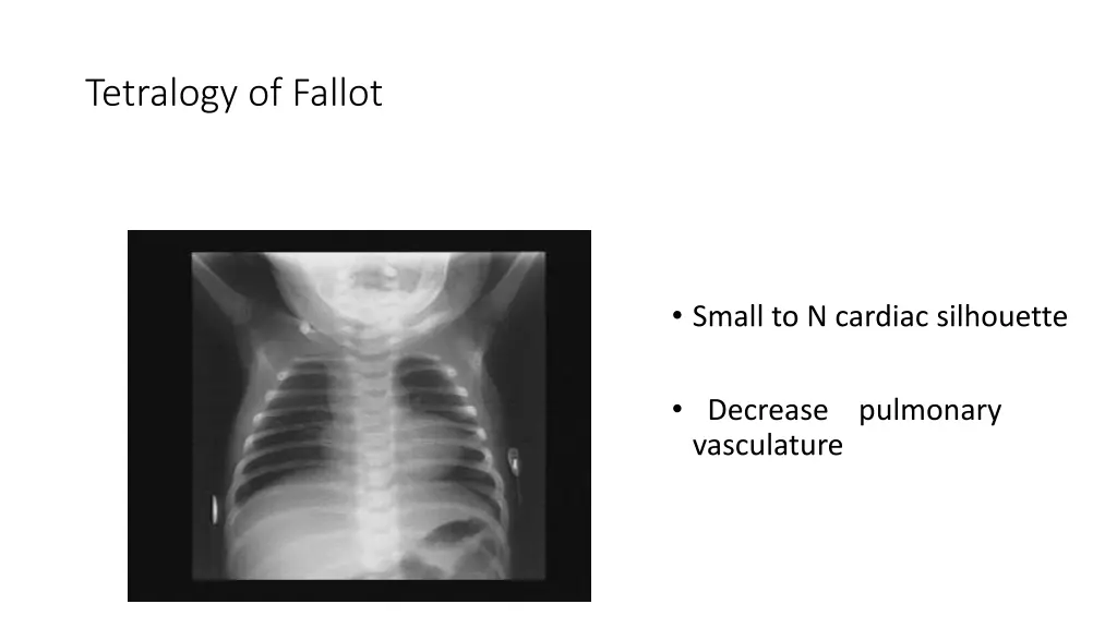 tetralogy of fallot 2