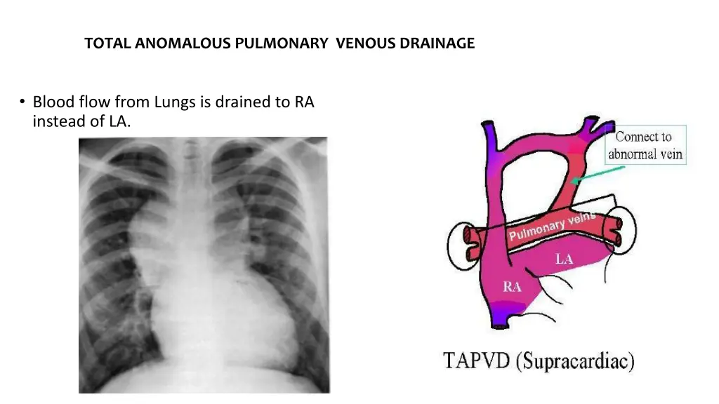 total anomalous pulmonary venous drainage