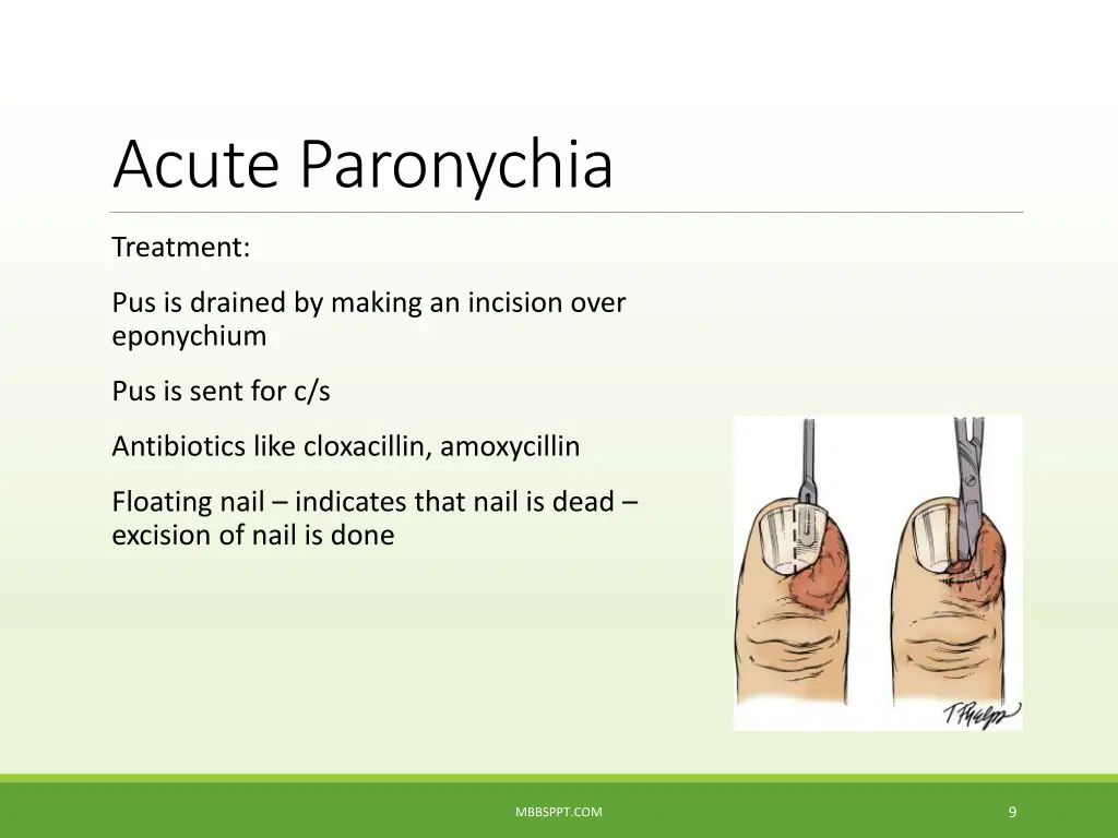 acute paronychia 3