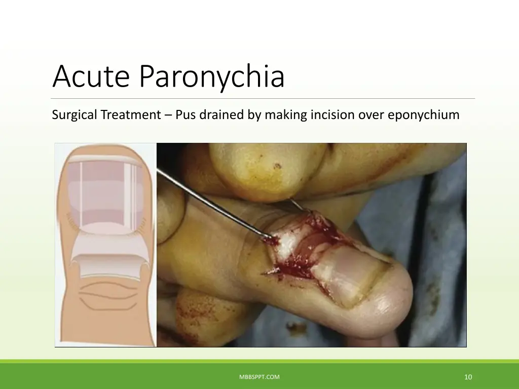 acute paronychia 4