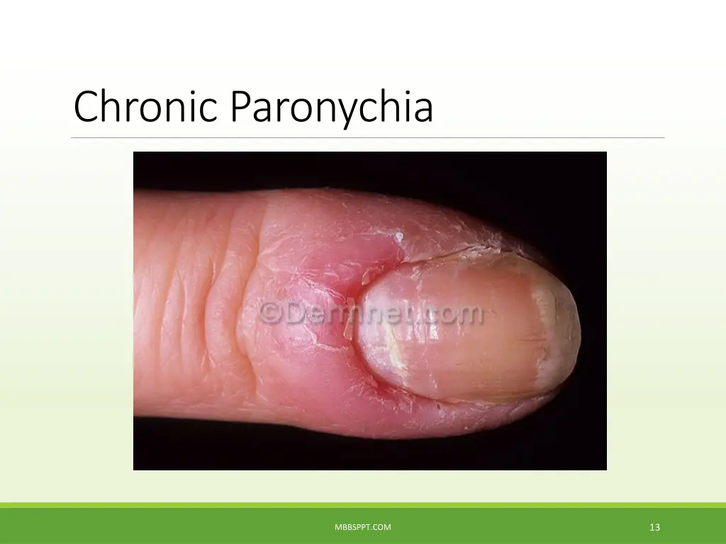 chronic paronychia 2
