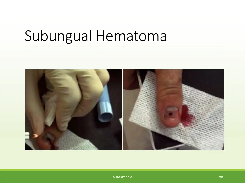 subungual hematoma 5