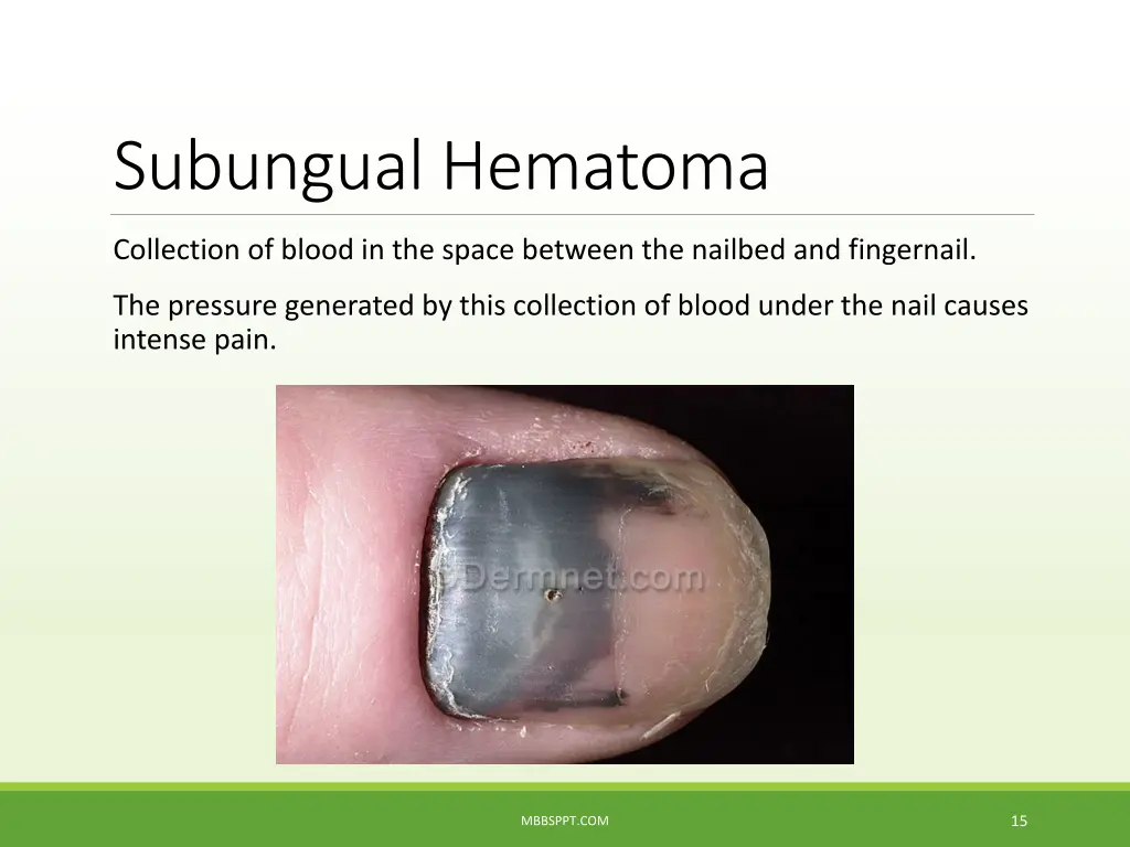 subungual hematoma