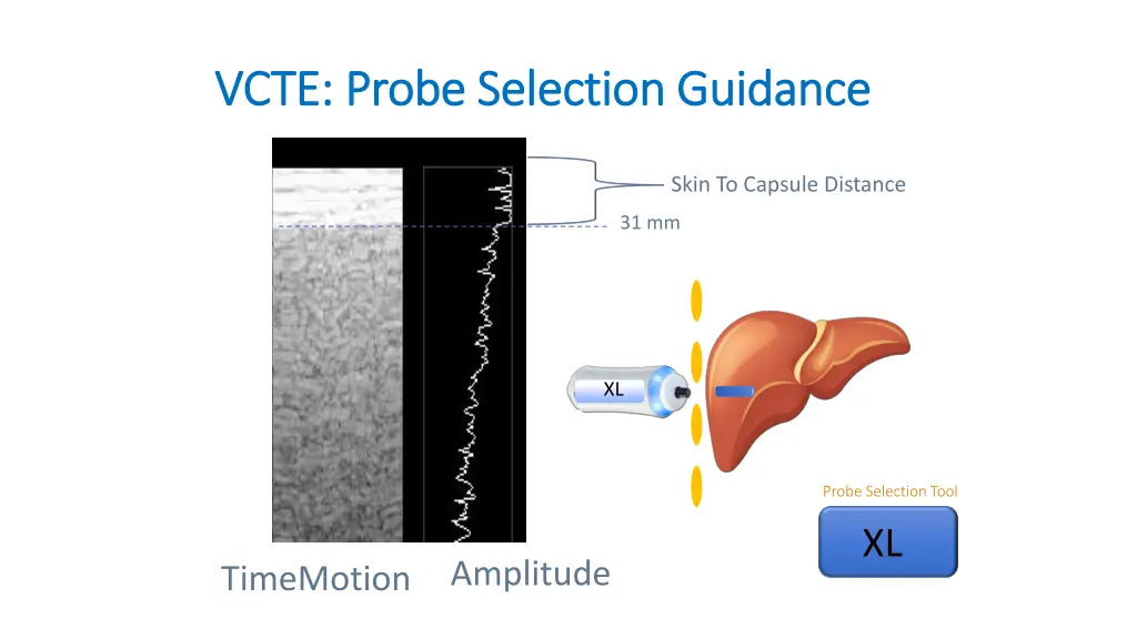 vcte probe selection guidance vcte probe