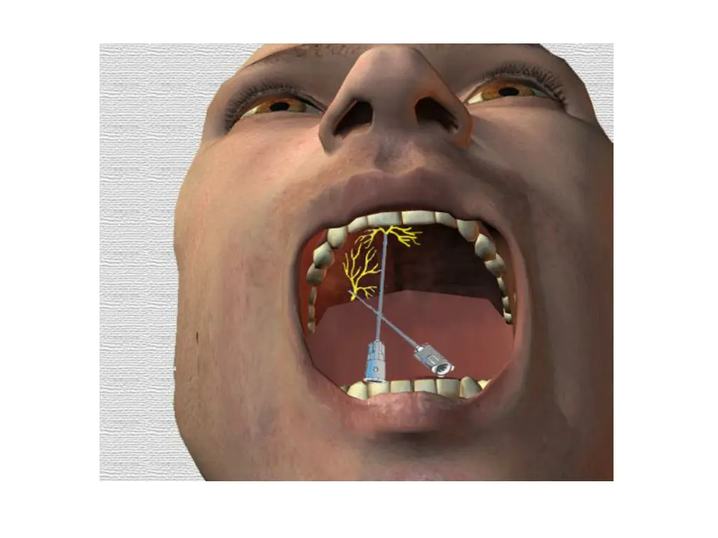 slide14