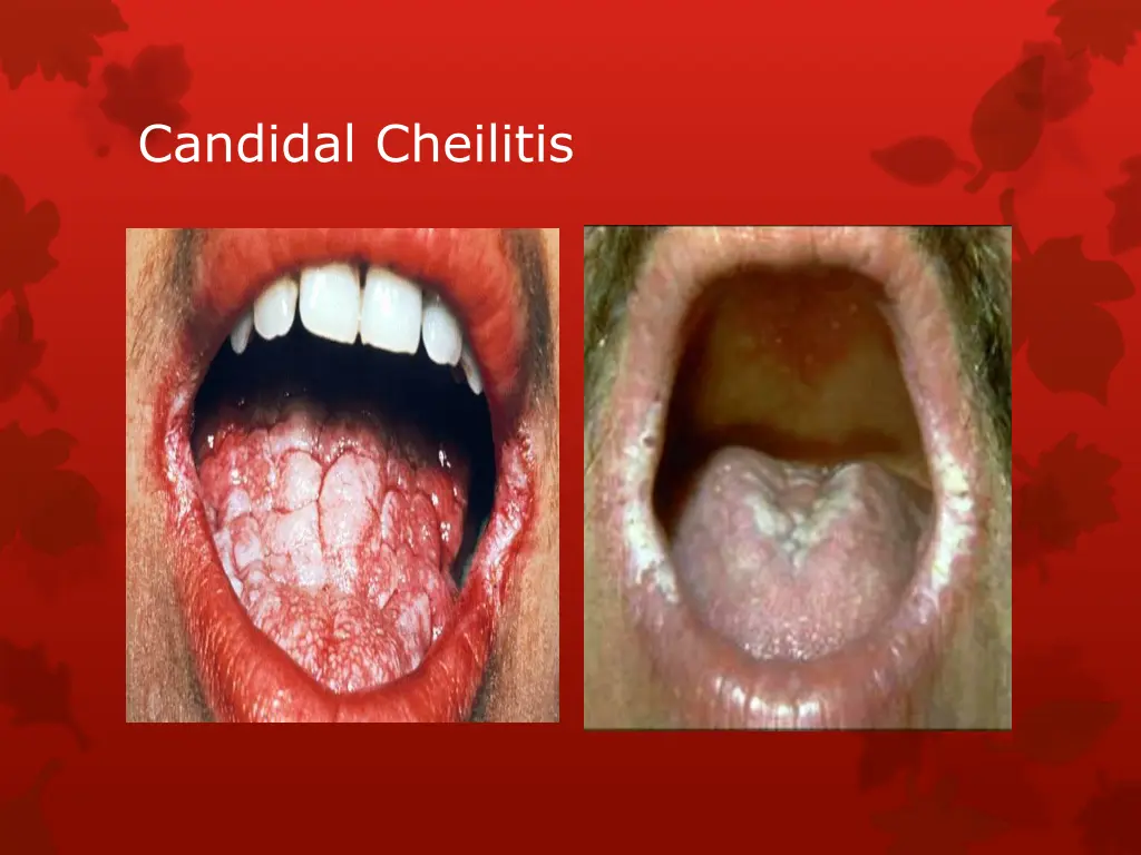 candidal cheilitis