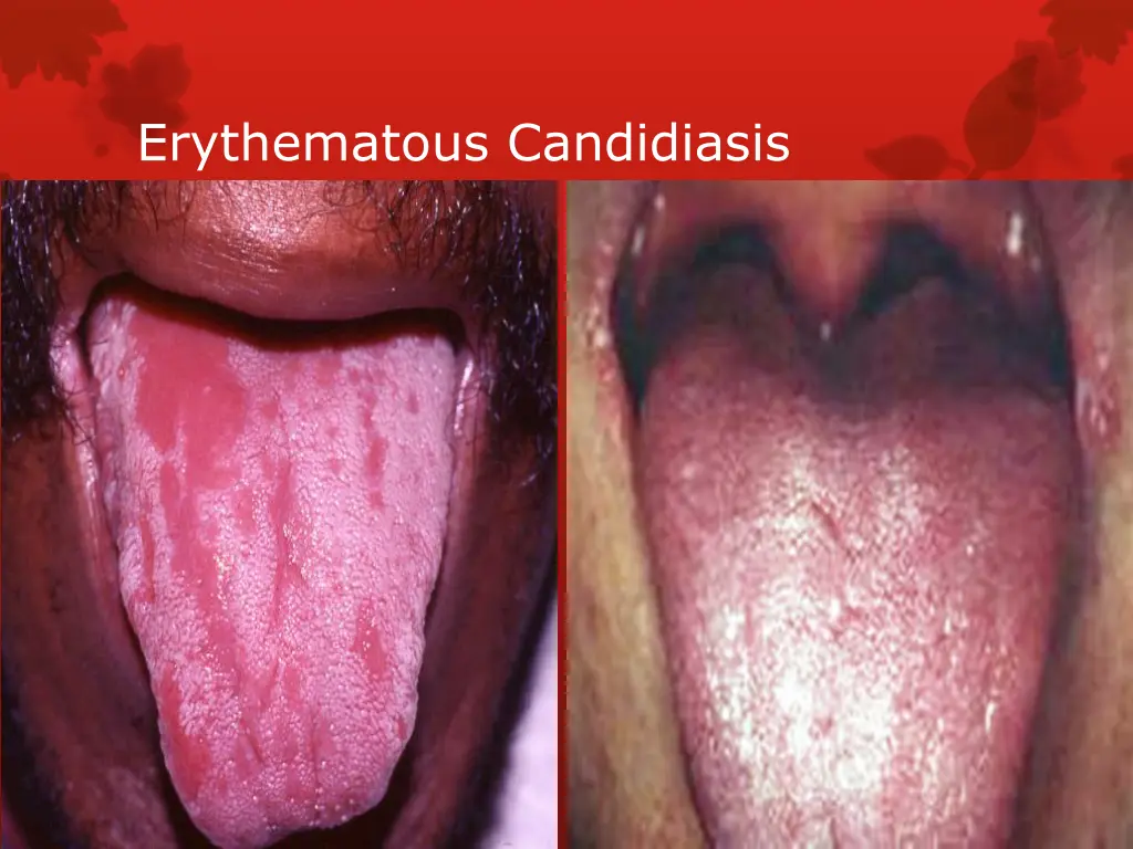 erythematous candidiasis