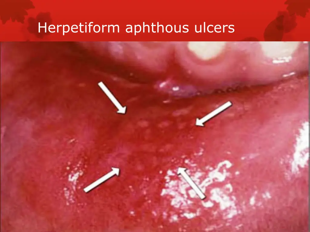 herpetiform aphthous ulcers
