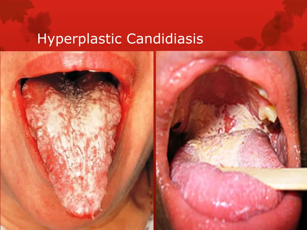hyperplastic candidiasis
