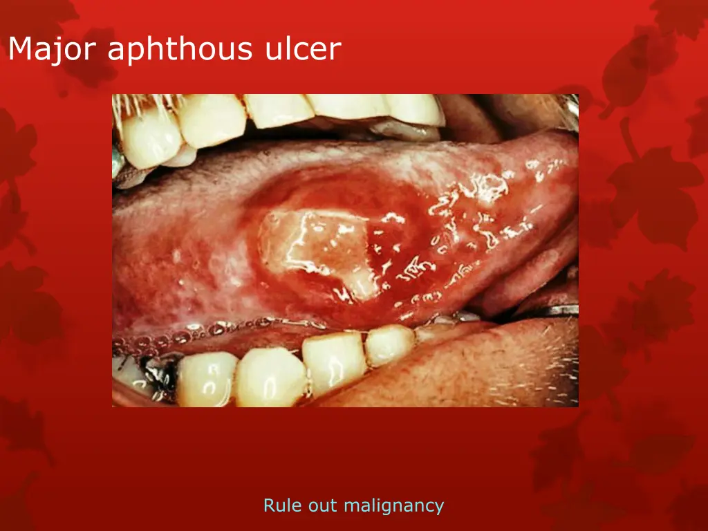 major aphthous ulcer