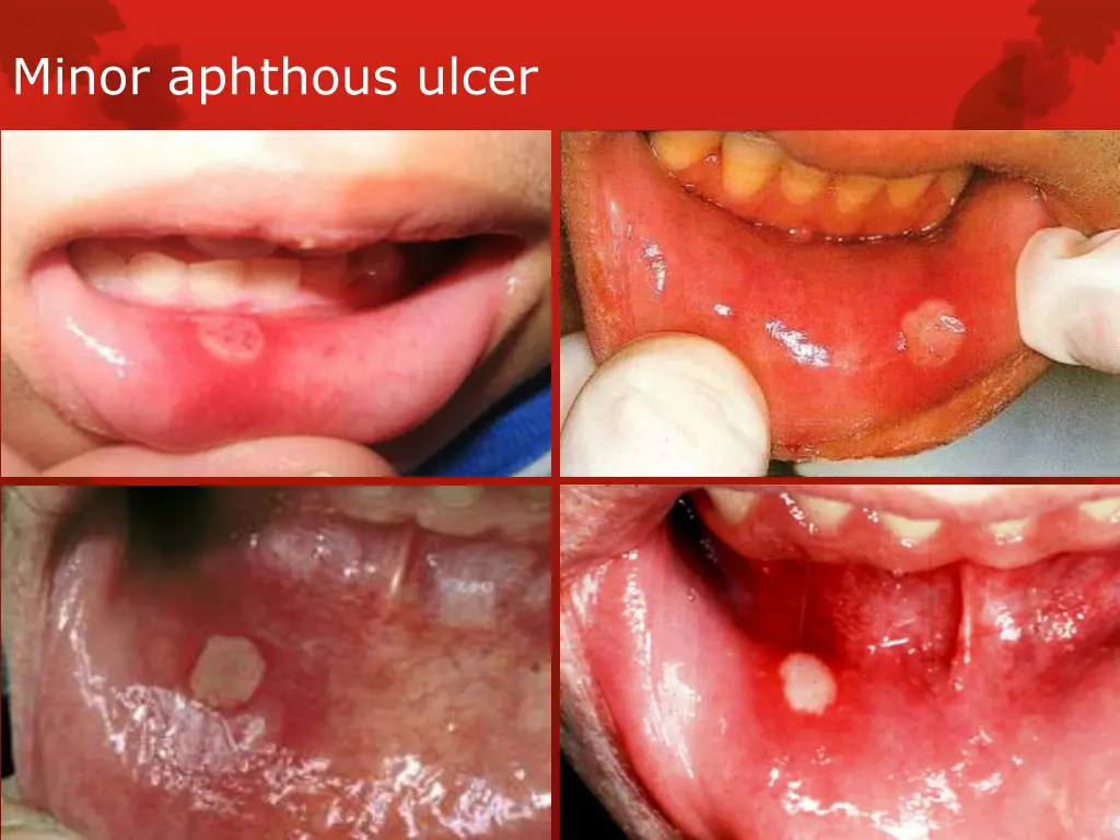 minor aphthous ulcer