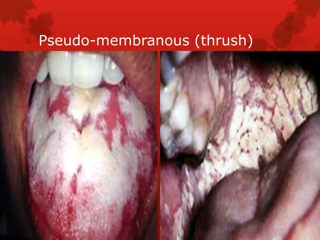 pseudo membranous thrush