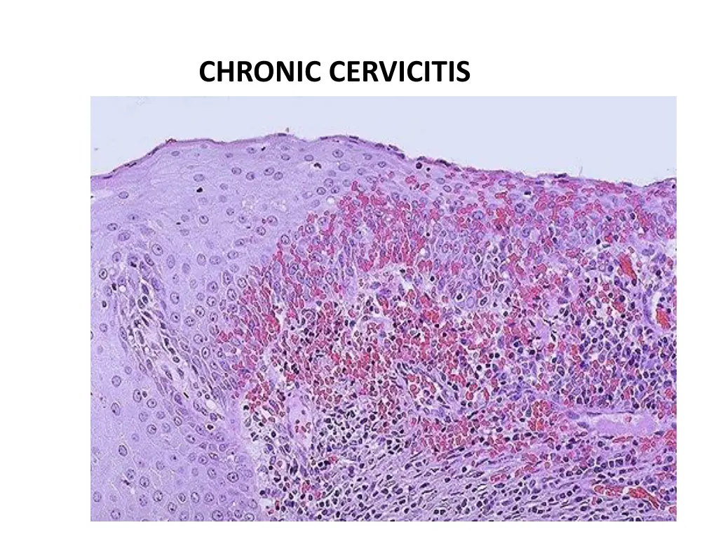 chronic cervicitis