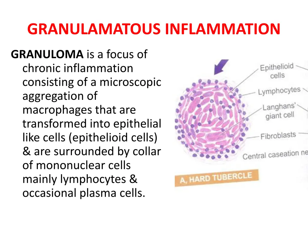 granulamatous inflammation