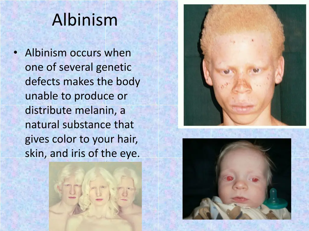 albinism