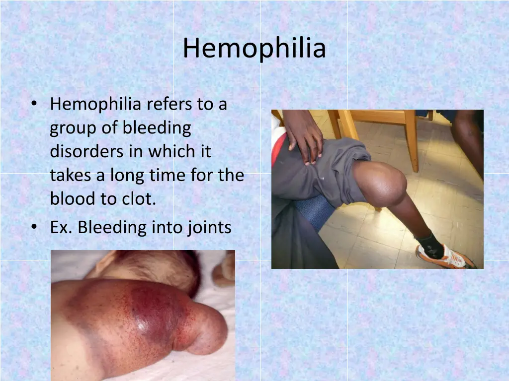 hemophilia