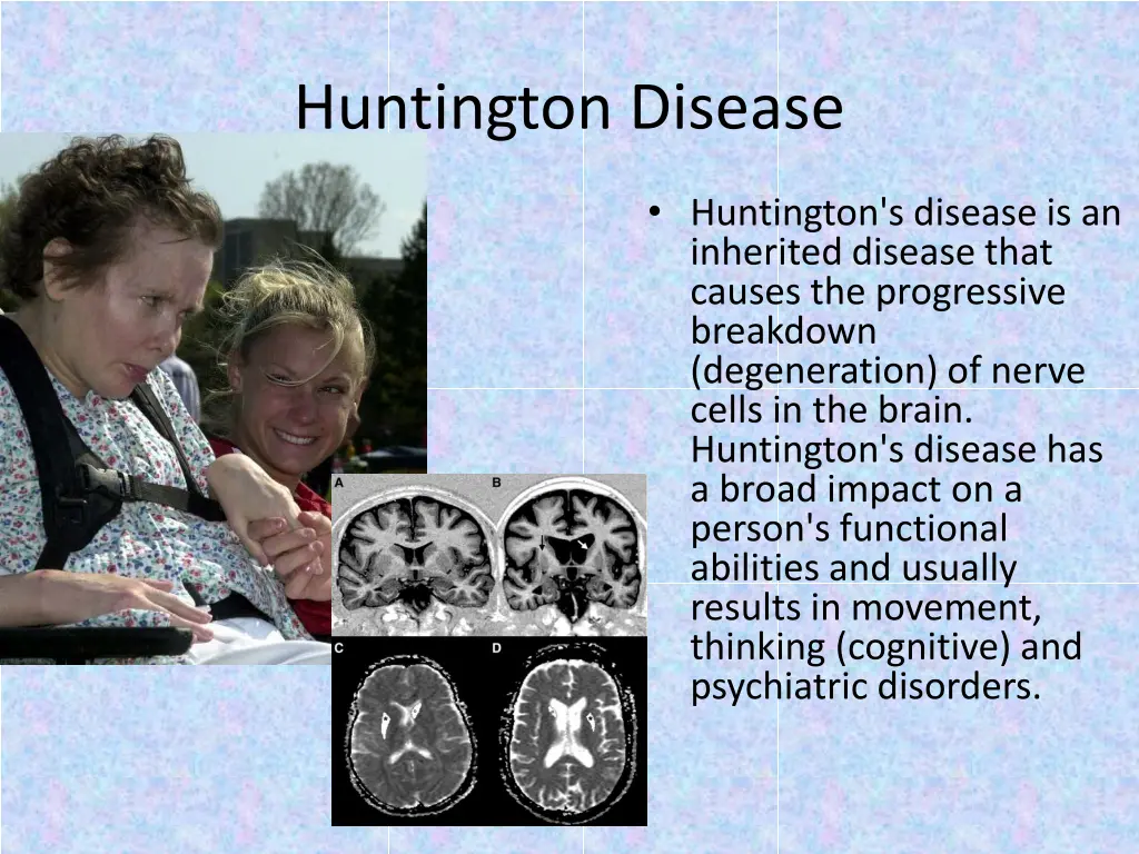 huntington disease