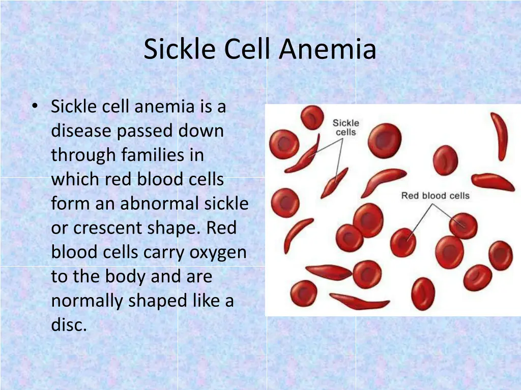 sickle cell anemia