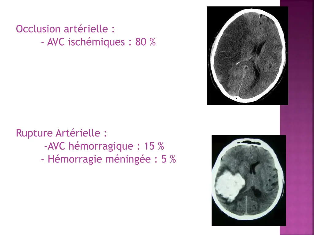 occlusion art rielle avc isch miques 80