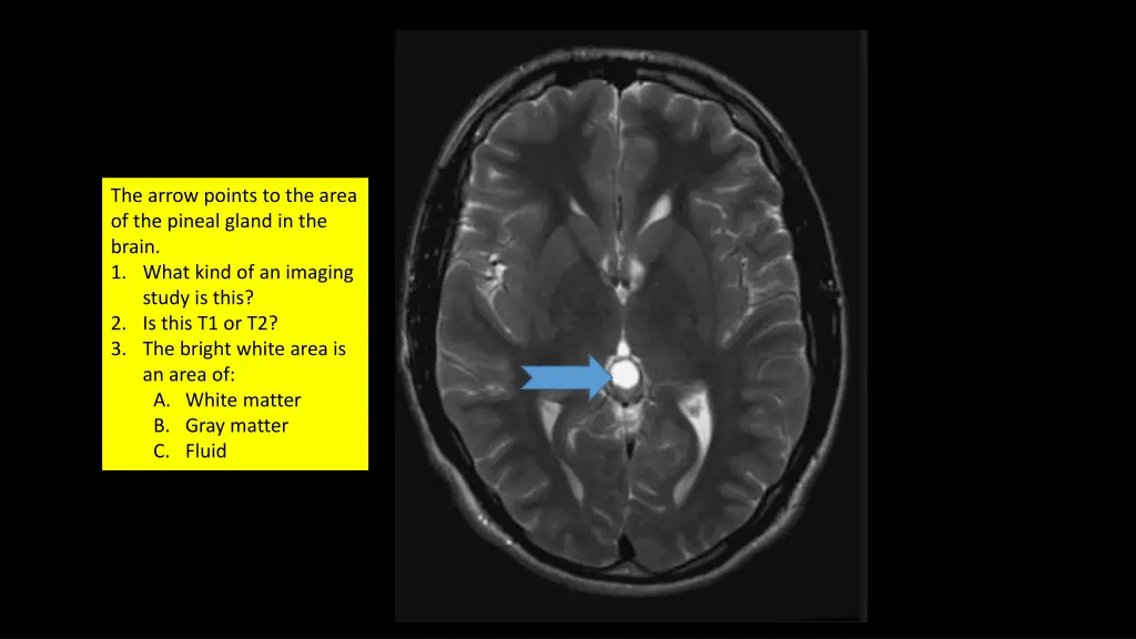 the arrow points to the area of the pineal gland