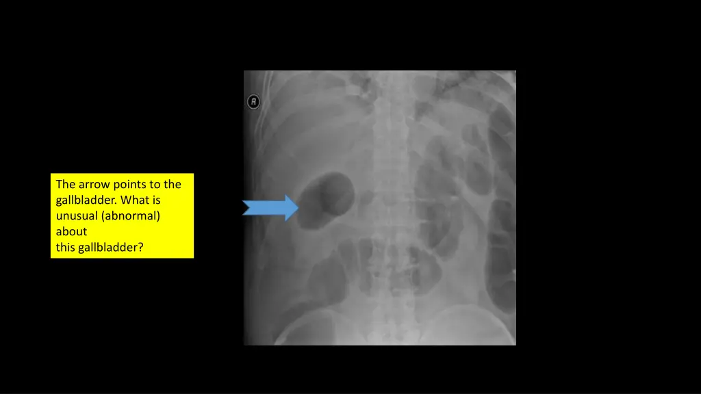 the arrow points to the gallbladder what