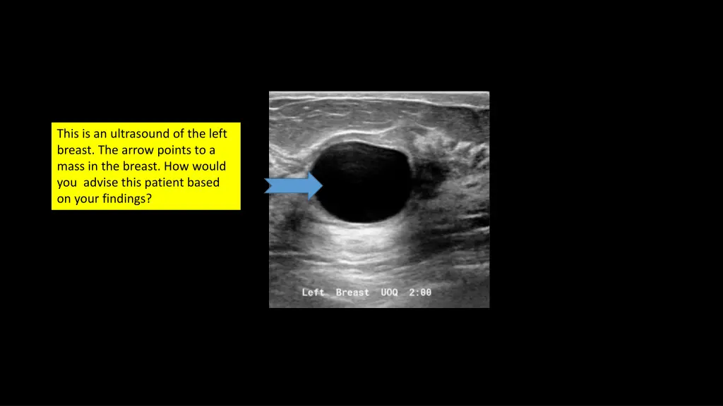 this is an ultrasound of the left breast