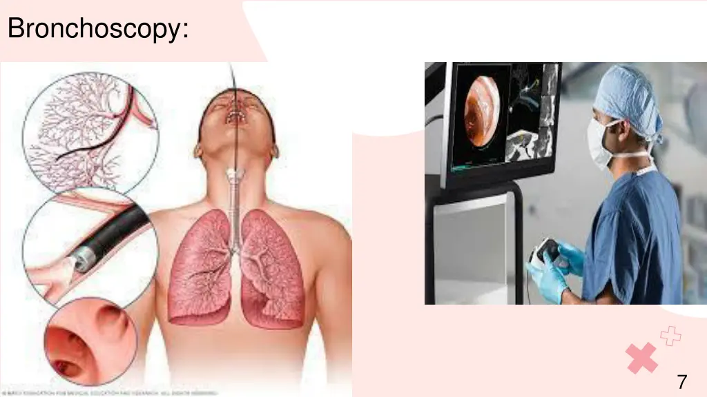 bronchoscopy