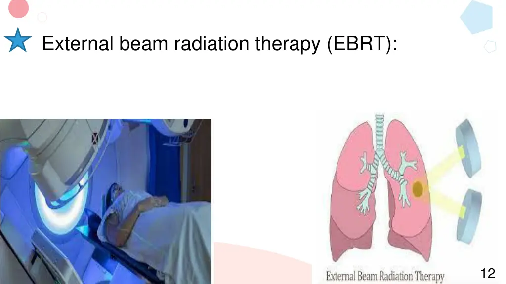 external beam radiation therapy ebrt