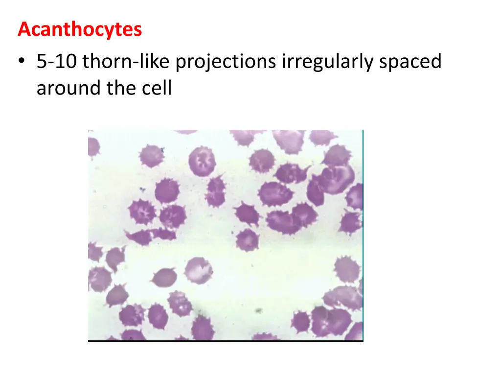 acanthocytes 5 10 thorn like projections