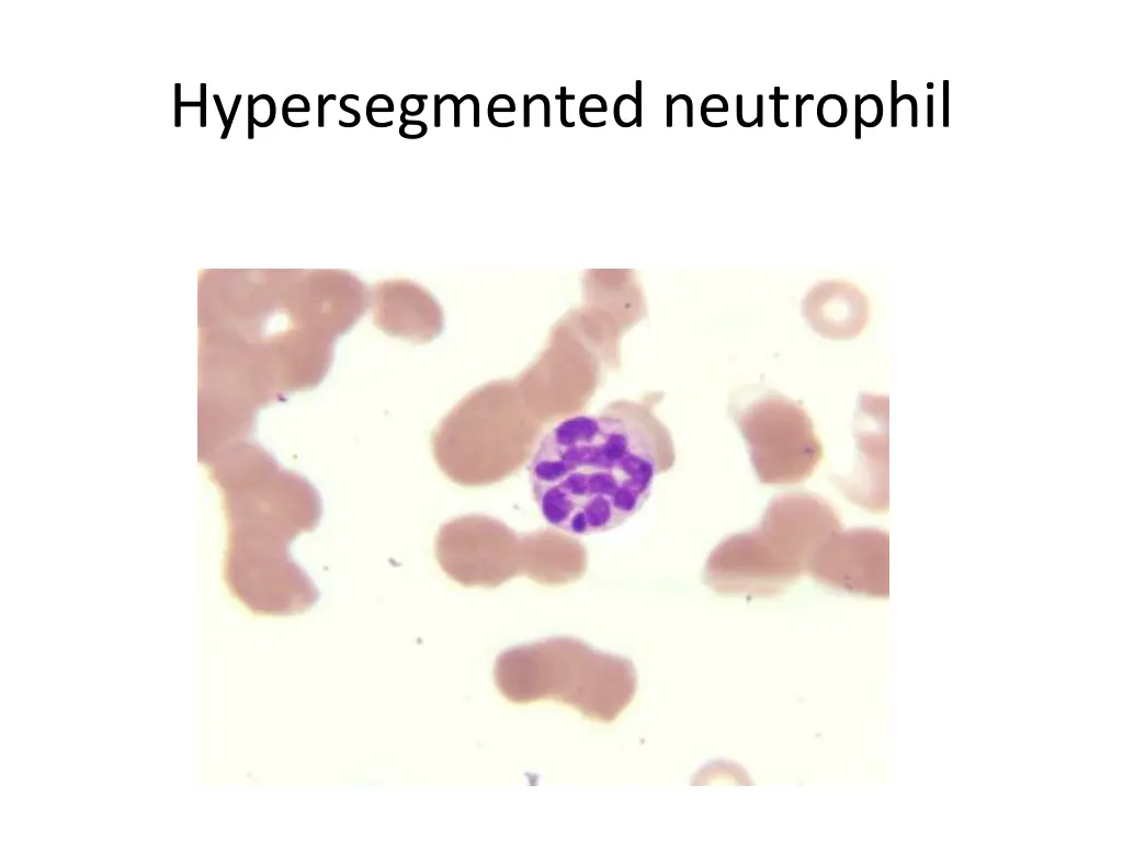 hypersegmented neutrophil