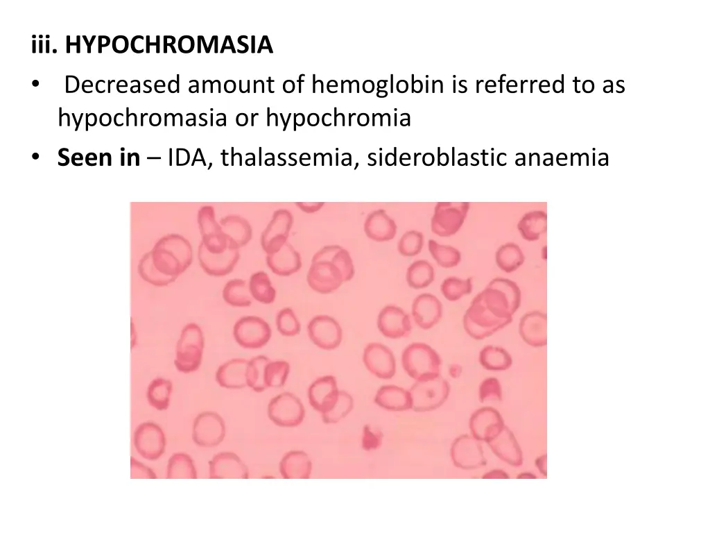 iii hypochromasia decreased amount of hemoglobin