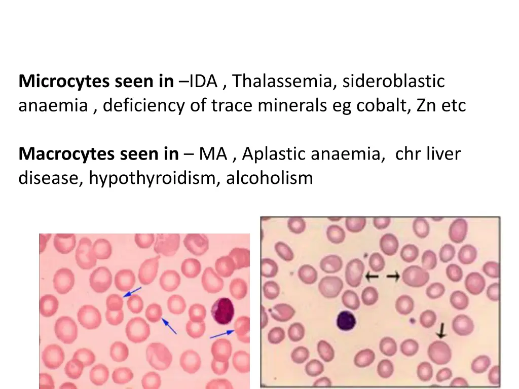 microcytes seen in ida thalassemia sideroblastic