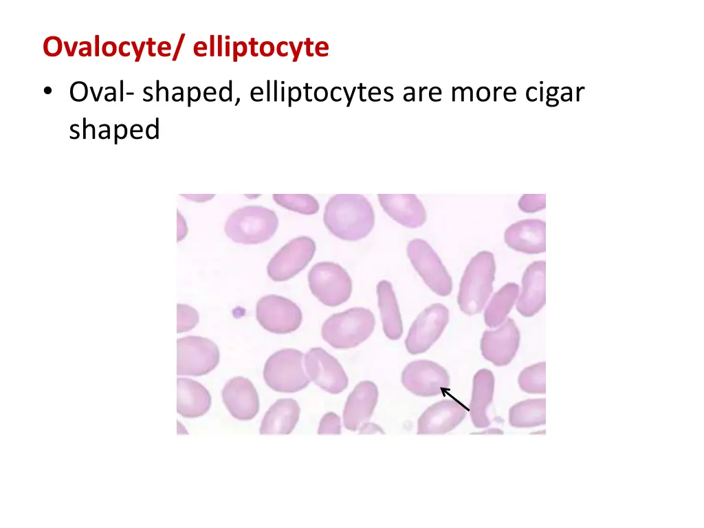 ovalocyte elliptocyte oval shaped elliptocytes