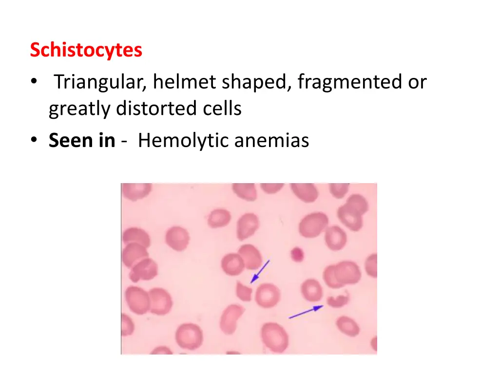 schistocytes triangular helmet shaped fragmented