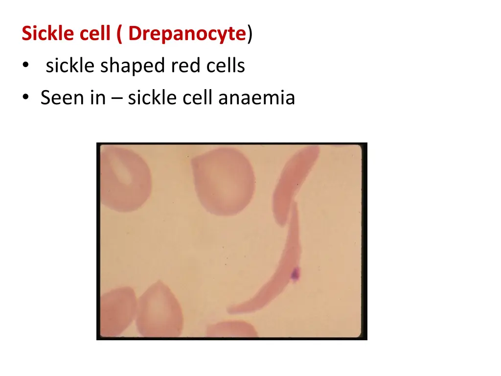 sickle cell drepanocyte sickle shaped red cells