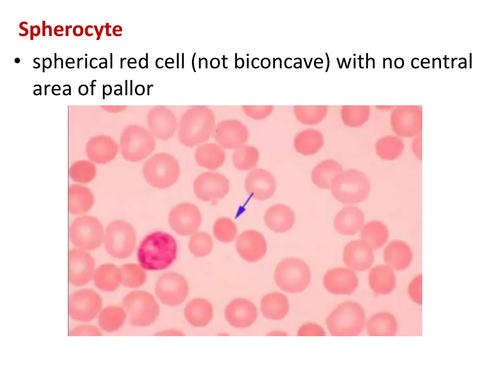 spherocyte spherical red cell not biconcave with