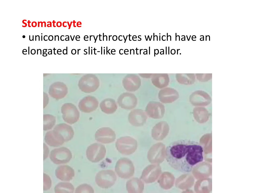 stomatocyte uniconcave erythrocytes which have