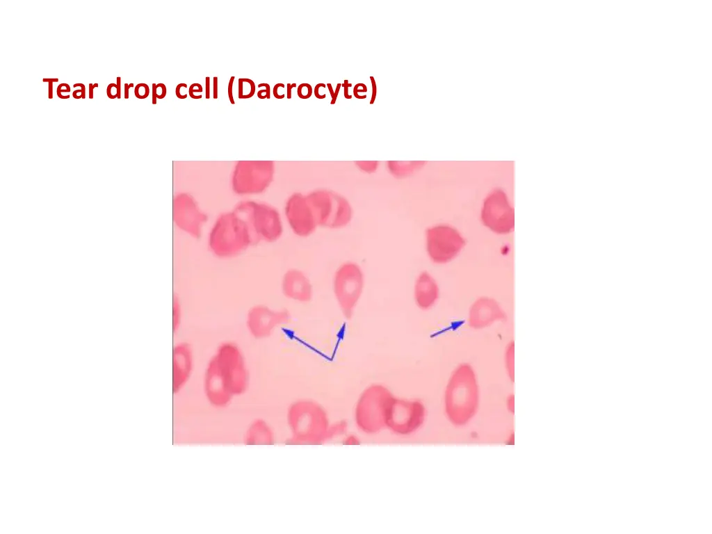 tear drop cell dacrocyte