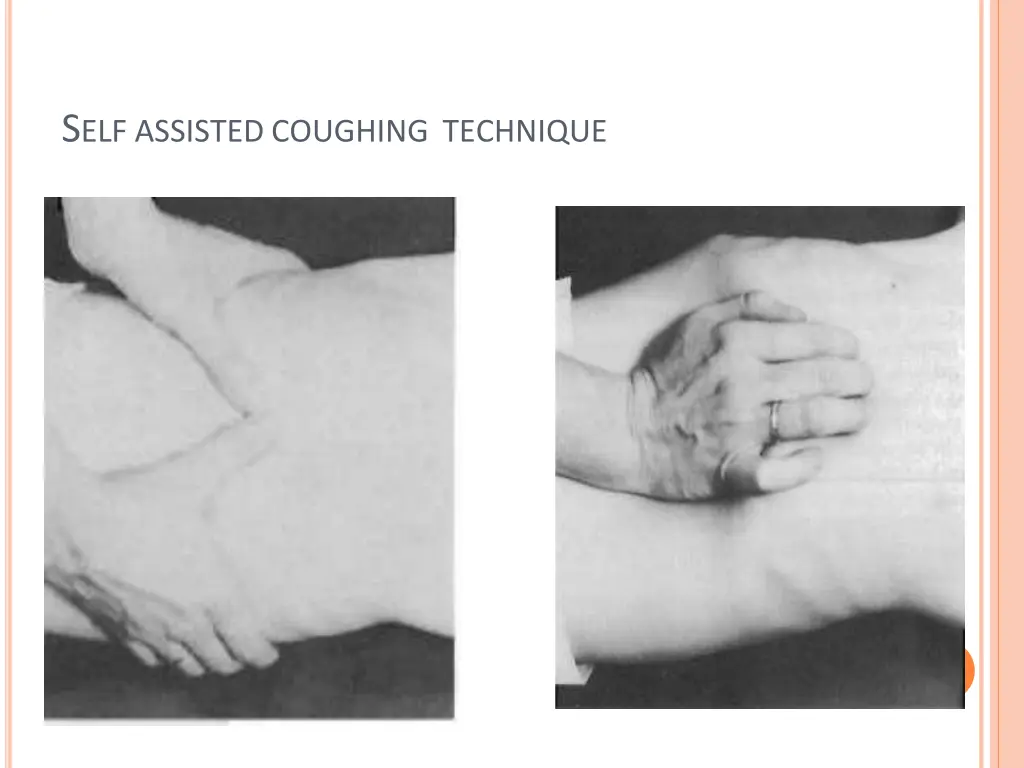 s elf assisted coughing technique
