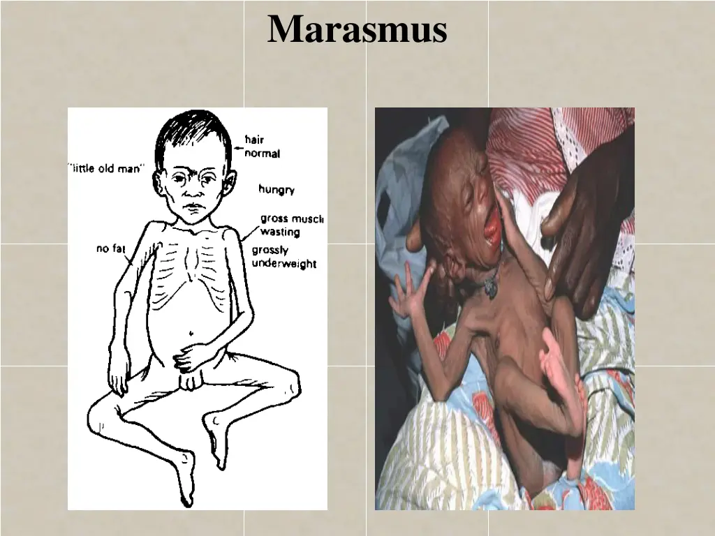 marasmus