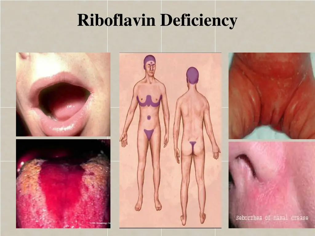 riboflavin deficiency