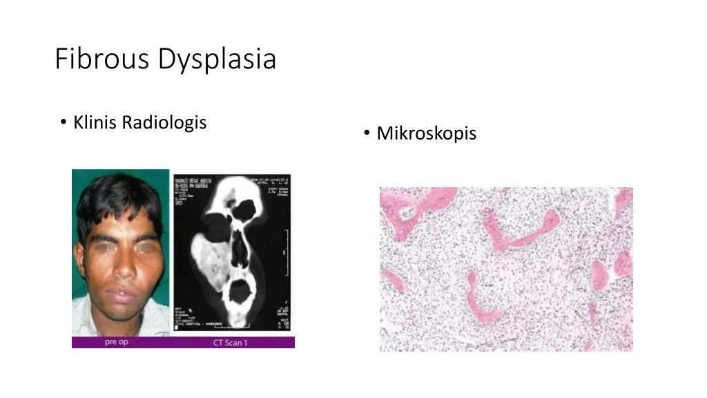 fibrous dysplasia