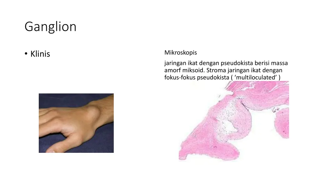 ganglion