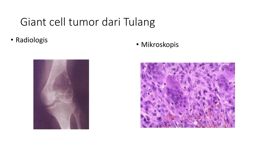 giant cell tumor dari tulang