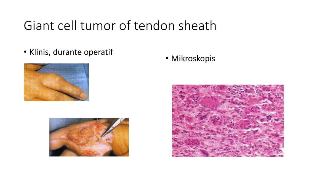 giant cell tumor of tendon sheath